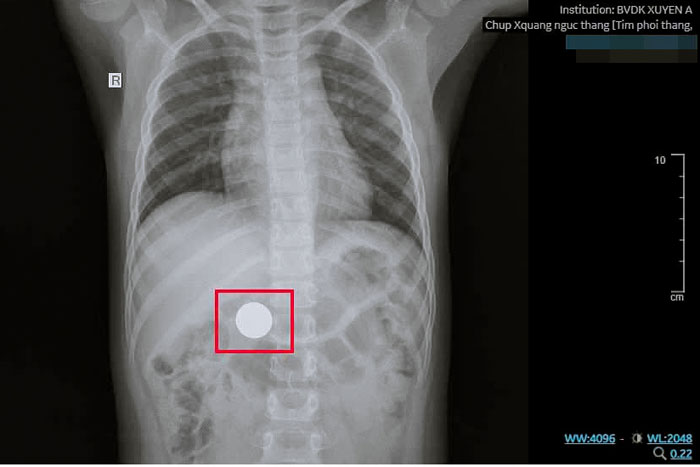 Các bác sĩ Khoa Nội soi BVĐK Xuyên Á Vĩnh Long gắp dị vật đồng xu do bé trai 6 tuổi vô tình nuốt.