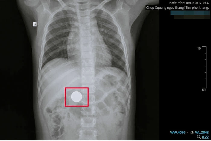 Phòng ngừa hóc dị vật