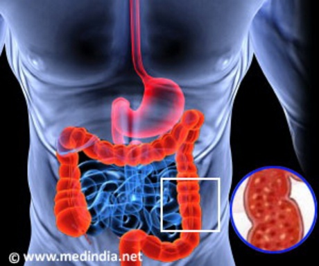 Giấm ăn có thể chữa viêm loét đại tràng ở chuộtẢnh: MEDINDIANET