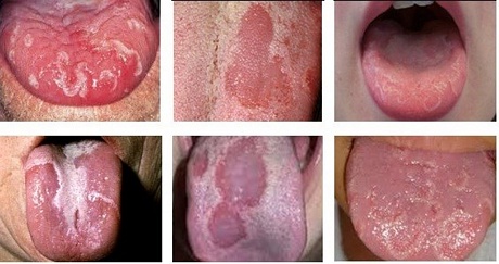 Một số hình thái tổn thương của ung thư lưỡi.