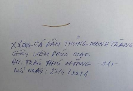 Chiếc xương cá dài 3cm được lấy ra từ ổ bụng ông Hoàng