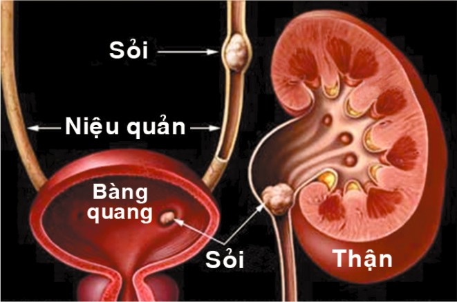 Sỏi tiết niệu thuộc phạm vi chứng “thạch lâm” của y học cổ truyền.