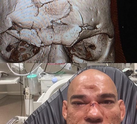 Santos dính chấn thương cực nặng. (Nguồn: Instagram)