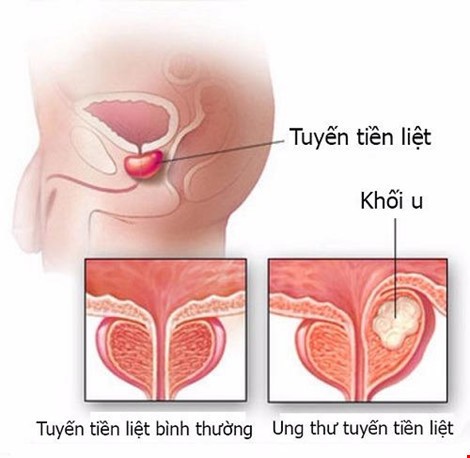 Ung thư tuyến tiền liệt rất nguy hiểm. Nam giới sau 50 tuổi nên làm kiểm tra PSA về bệnh này (ảnh minh họa)