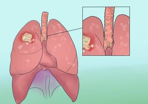 Ung thư phổi là bệnh ung thư nguy hiểm nhất trong số tất cả các bệnh ung thư.