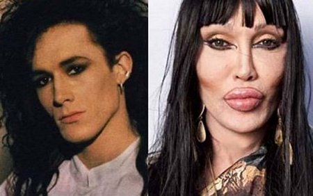 Pete Burns trước và sau khi phẫu thuật thẩm mỹ. (Ảnh: Idistracted).