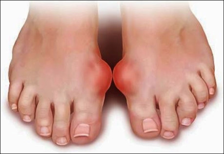 Người mắc bệnh Gout: Lạc là thực phẩm có nhiều chất béo, sẽ làm ảnh hưởng đến khả năng bài tiết axit uric trong khớp qua nước tiểu, làm nặng thêm bệnh tình. Vì vậy, người bị bệnh Gout cấp tính tuyệt đối không được ăn lạc.