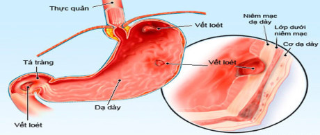 Người bị bệnh dạ dày cũng không nên ăn lạc, vì lạc sẽ gây đầy hơi, chướng bụng.