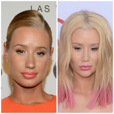 Iggy Azalea - Sau khi thừa nhận nâng ngực và bơm mông, nữ rapper đình đám này lại khiến dư luận và người hâm mộ bất ngờ khi tiếp tục gọt cằm và sửa mũi.