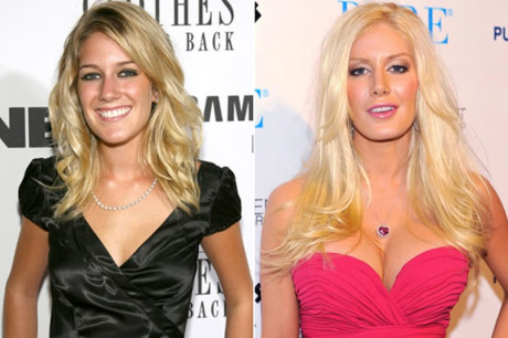 Heidi Montag từng đi nâng ngực vào năm 2010, tuy nhiên bác sĩ đã làm quá đà khiến hai gò bồng đảo của cô căng phồng như hai trái bóng. Ngôi sao đã chịu không ít bất tiện và cơn đau từ bộ ngực đồ sộ này. Nó khiến cô mắc bệnh thoát vị đĩa đệm cổ và tê tay vì dây thần kinh bị chèn ép.