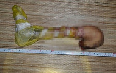 Đoạn cẳng chân phát hiện ở bãi rác