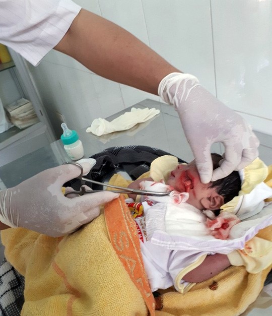 Cháu bé được các bác sĩ cấp cứu hô hấp, rửa vết thương trên mặt