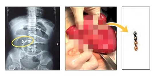 4 viên bi được lấy ra từ bụng bé gái. Ảnh BVCC