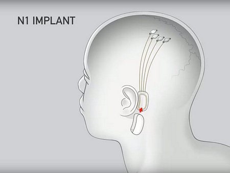 Chip được gắn sau tai, thu tín hiệu từ điện cực gắn ở dây mềm. Ảnh: Neuralink