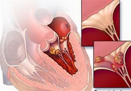 Theo các bác sĩ, viêm cơ tim rất hiếm gặp.