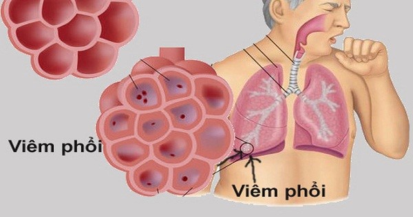 Viêm phổi do vi rút. Ảnh minh hoạ: Vvvienyhocungdung.