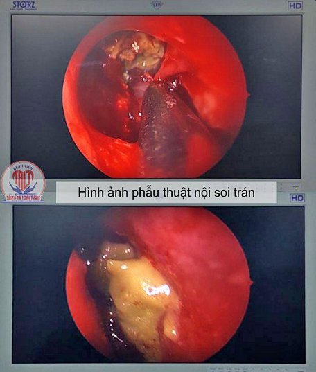 Phần nấm trong xoang trán có màu sáng.