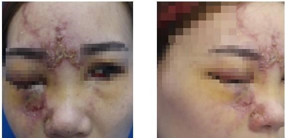 Một bệnh nhân bị tai biến do tiêm filler. Ảnh minh họa. (Nguồn: Vietnam+)