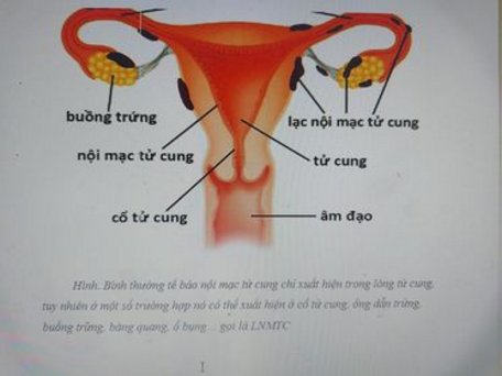 Bình thường tế bào nội mạc tử cung chỉ xuất hiện trong lòng tử cung, song ở một số trường hợp nó có thể xuất hiện ở cổ tử cung, ống dẫn trứng, buồng trứng, bàng quang, ổ bụng… gọi là lạc nội mạc tử cung.