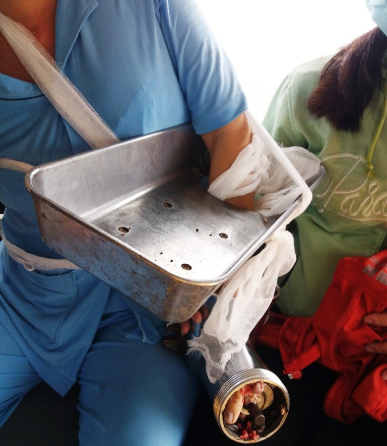 Bàn tay bà Đ. bị cuốn vào cối xay thịt.