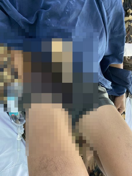 BN bị dị vật đân vùng hạ vị được giữ nguyên khi đưa đến bệnh viện.